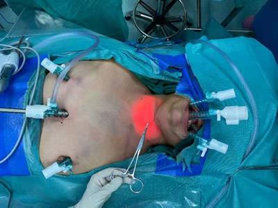 A novel hybrid approach for “Scarless” (at the neck) lateral neck dissection for papillary thyroid carcinoma: A case series and literature review